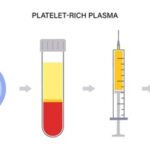 Exploring PRP Therapy: A New Hope for Knee Pain Relief