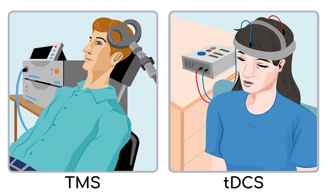 Differences Between tDCS and Other Neurostimulation Techniques