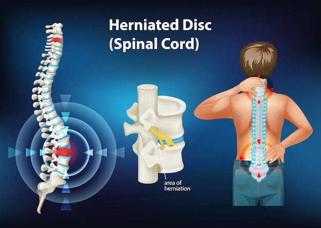 Disc Herniation and Sciatica