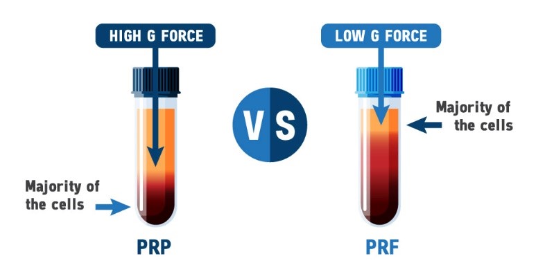 How PRF Differs from PRP