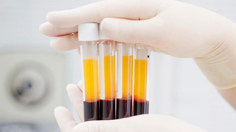 Understanding Platelet-Rich Fibrin