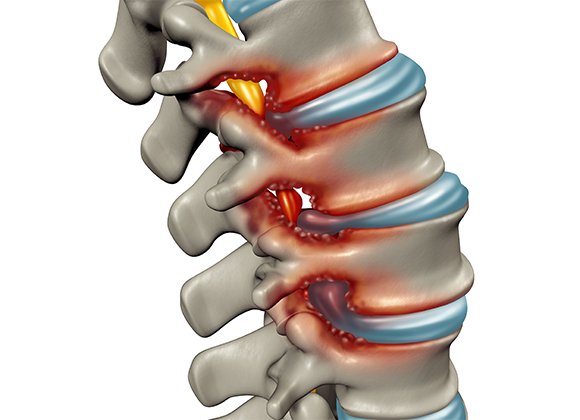 What is Degenerative Disc Disease